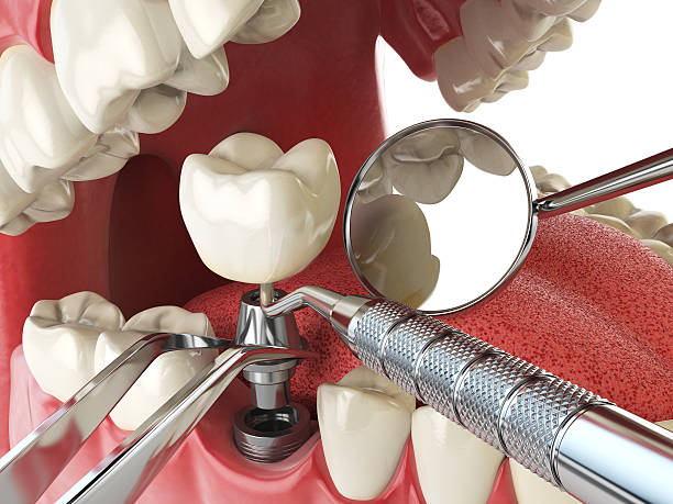 Best Same-Day Emergency Dentist in Cross Mountain, TX